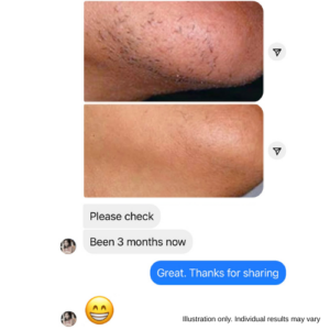 chin hair removal