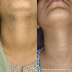 uzhra facial hair treatment review